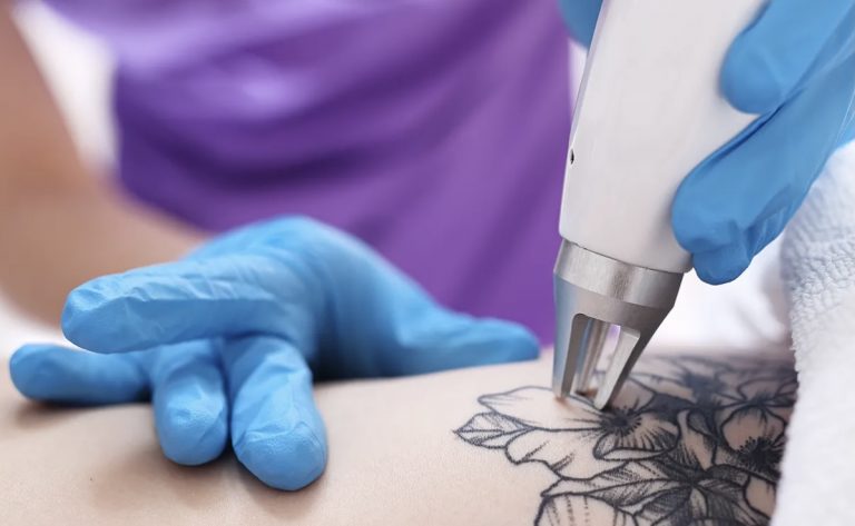 laser-tattooentfernung